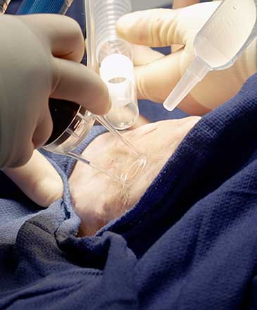 burn scar laser therapy