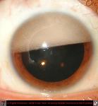 Emulsified Silicone Oil in Anterior Chamber