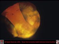 Congenital Ocular Malformation with Duplicated Anterior Segment