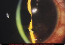 Intraocular Metallic Foreign Body in Anterior Chamber