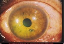 Intraocular Metallic Foreign Body in Anterior Chamber