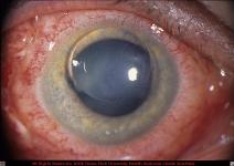 Spontaneous Hyphema with Clot Secondary to Warfarin