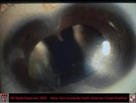 Congenital Ocular Malformation with Duplicated Anterior Segment