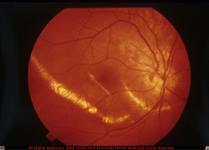 Choroidal Rupture