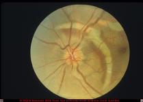 Choroidal Rupture