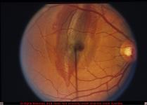 Choroidal Rupture