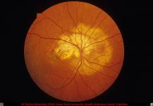 Choroidal Osteoma with Associated Choroidal Neovascular Membrane