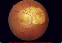 Choroidal Osteoma