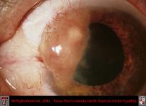 Conjunctival Melanoma