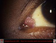 Conjunctival Papilloma