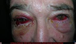 Hemorrhagic Conjunctivitis (negative imaging for orbital disease)