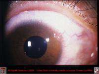 Conjuctival Limbal Phlyctenule