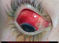 Hemorrhagic Conjunctivitis Secondary to Conxsackie Virus