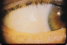 Conjunctival and Corneal Metallic Foreign Bodies After Blast Injury