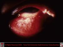 Chlamydia Conjunctivitis