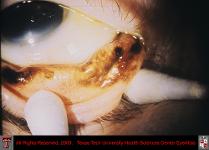 Conjunctival Melanoma