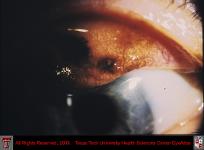 Conjunctival Melanoma