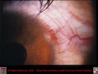 Conjuctival Limbal Phlyctenule