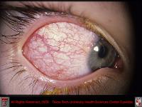 Conjuctival Limbal Phlyctenule