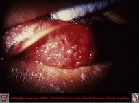 Chlamydia Conjunctivitis