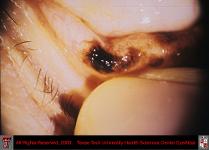 Conjunctival Melanoma