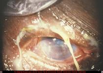 Bacterial Conjunctivitis with Corneal Ulceration Due to Pseudomonas