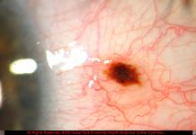 Conjunctical Nevus