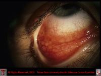 Conjunctival Folliculosis