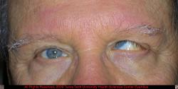 Severe Left Hypertropia and Esotropia