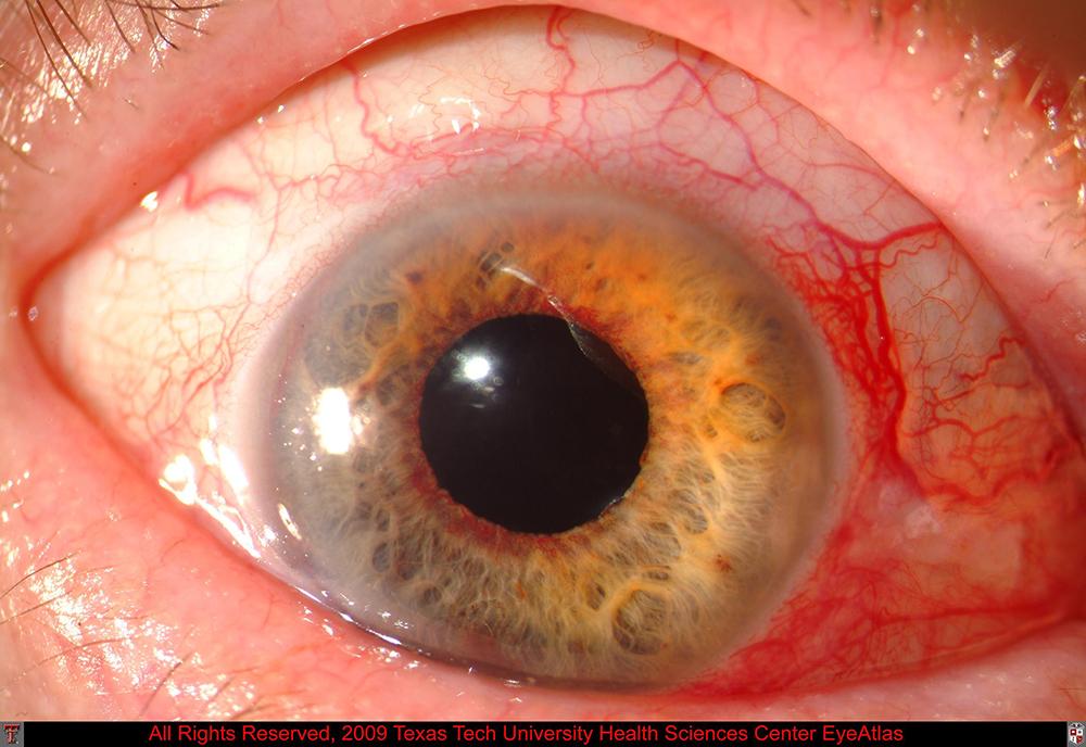 Iris and Ciliary Body (Glaucoma, Uveitis) | Texas Tech University