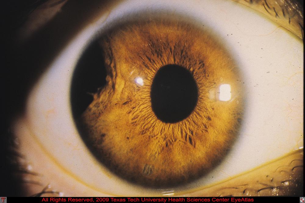 Iris and Ciliary Body (Glaucoma, Uveitis) | Texas Tech University