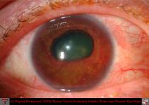 Extensive Neovascularization of Iris With Ectropion Uveae Due to Neovascular Glaucoma