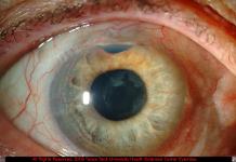 Extensive Neovascularization of Iris Due to Neovascular Glaucoma