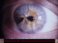 Partial Iris Repair After Trauma