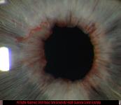 Extensive Iris Neovascularization