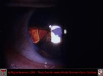 Partial Iris Repair After Trauma Retroillumination