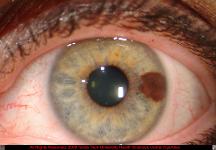 Iris Melanoma