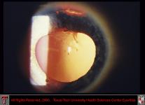 Iridodialysis and Anterior Subcapsular Cataract After Trauma