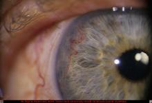 Anomalous Iris Vessels