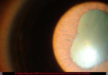 Posterior Synechaie Due to Uveitis