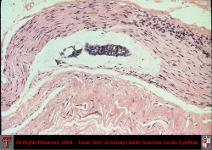Adenoid Cystic Carcinoma