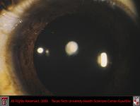 Anterior Polar Cataract