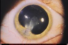 Penetrating Ocular Injury With Corneal Laceration and Focal Traumatic Cataract