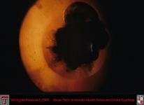 Congenital Cataract