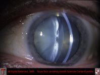 Mature Cataract