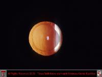 Anterior Capsular Phimosis Retroillumination