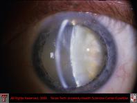 Mature Cataract