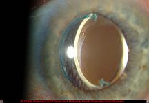 Intraocular Lens Implant Subluxation