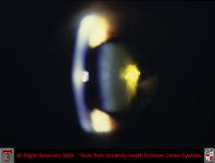 Focal Posterior Polar and Subcapsular Cataract