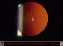 Traumatic Anterior Subcapsular Cataract Retroillumination